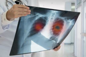 lung xray
