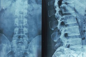 spinal cord x-ray