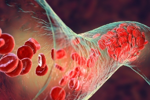 Internal view of bloodclot in the body.