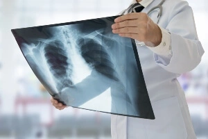doctor holding up X-ray of chest, no face showing