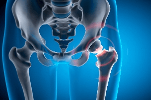 X-ray graphic of hip injury