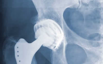 hip replacement xray